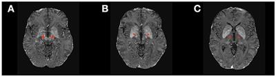 New Frontiers for Deep Brain Stimulation: Directionality, Sensing Technologies, Remote Programming, Robotic Stereotactic Assistance, Asleep Procedures, and Connectomics